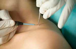 Skin Tag Removal in Norwich